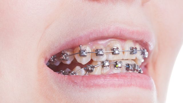 brackets metalicos