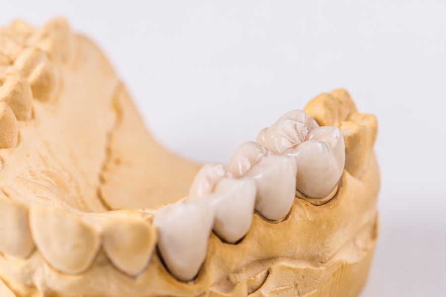 Prótesis dental fija o removible, ¿Qué diferencias hay?